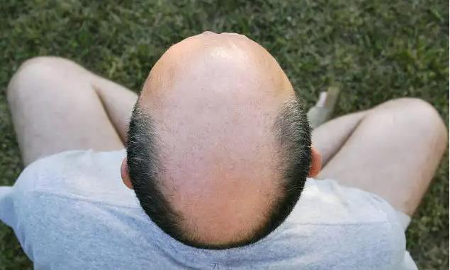 What does it mean to dream of baldness